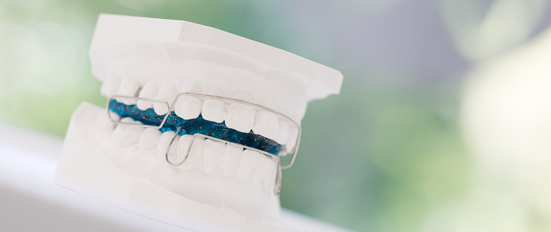 Gipsmodell mit herausnehmbarer Zahnspange