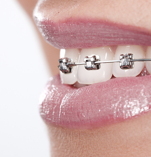 Aufnahme einer festen Zahnspange